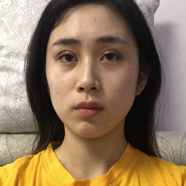 无锡施尔美医院切开双眼皮案例分享!