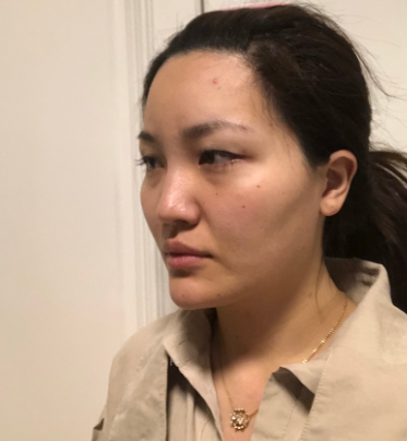 上海光博士门诊部医生李彬眼部手术案例分享!