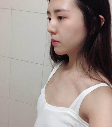 厦门妹纸假体隆胸术后果分享!