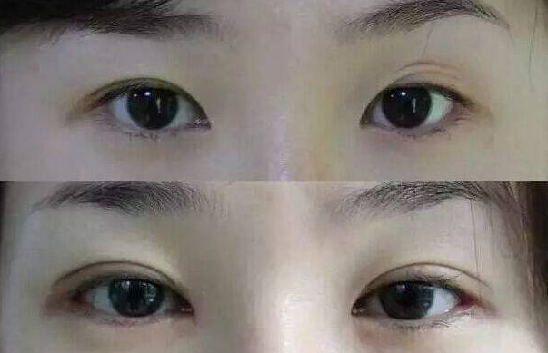 上海九院整形科张英做双眼皮手术怎么样?