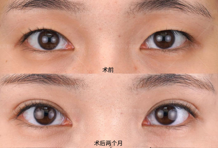 上海九院整形科张英双眼皮手术怎么样?