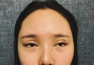 沈阳名流美容医院王旭做双眼皮手术怎么样?