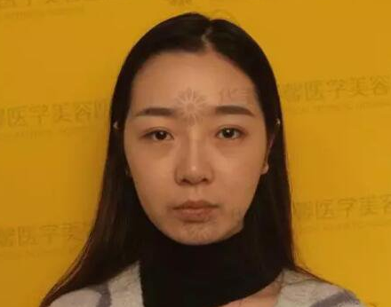 四川华美整形医院艾玉峰做隆鼻手术怎么样?