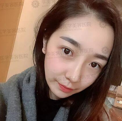 四川华美整形医院艾玉峰做隆鼻手术怎么样?