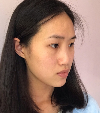温州和平整形医院医生梁赞姜隆鼻案例分享!