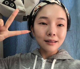 丰泽黄惠铭医疗美容诊所切开双眼皮案例分享!