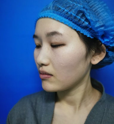 北京蜜邦医疗美容肋软骨隆鼻案例分享!