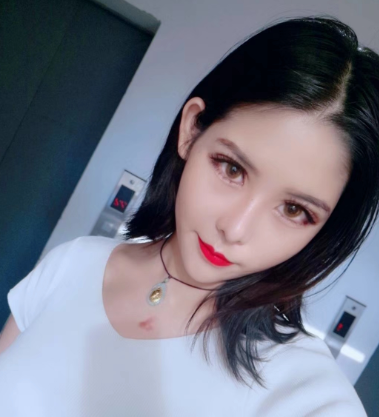 苏州美贝尔医院隆鼻术后果分享!
