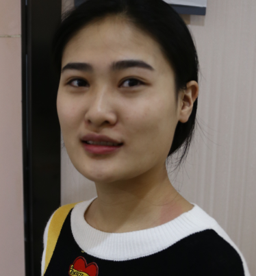 深圳阳光整形医生罗志敏隆鼻下颌角案例分享!