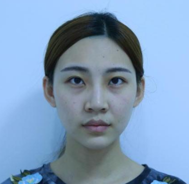 四川美莱切开双眼皮术后八十天案例果分享!