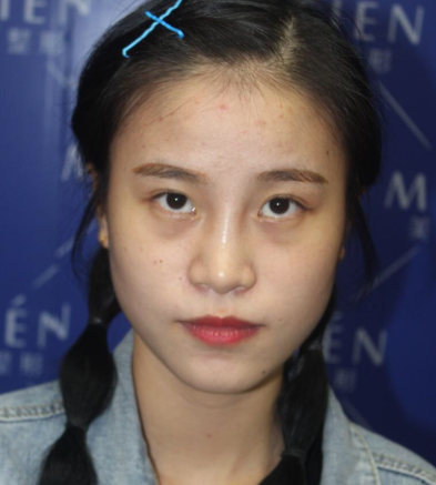 广东美恩整形医生陈宏彬眼部手术案例分享!