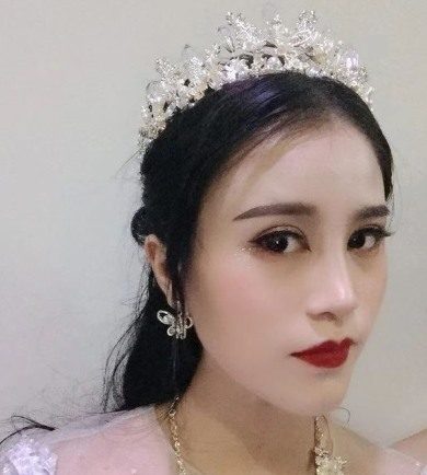 广东美恩整形医生陈宏彬眼部手术案例分享!