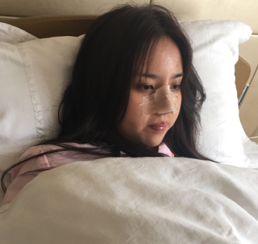 杭州艺星医美医生徐利刚鼻部多项案例分享!
