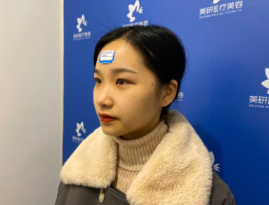 长沙爱美者双眼皮术后果案例分享!
