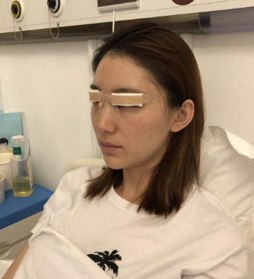 合肥壹加壹医美切开双眼皮案例分享!