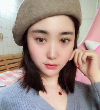 合肥壹加壹医美切开双眼皮案例分享!