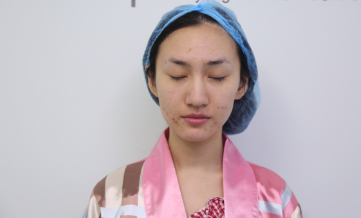 沈阳杏林整形外科医院切开双眼皮果怎么样?