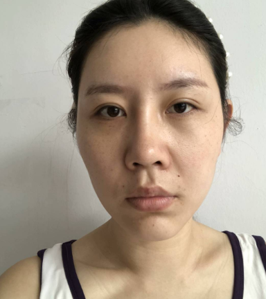 医疗美容医生刘歆自体脂肪全脸填充案