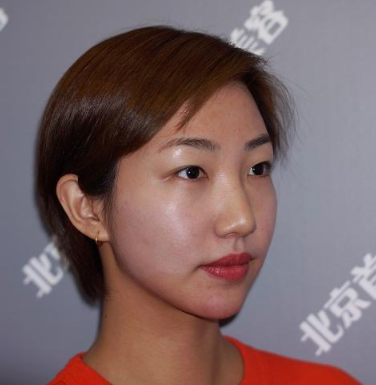 北京首玺丽格医疗美容诊所面部埋线提升果案例