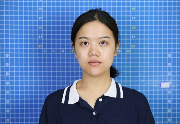 新疆乌鲁木齐华美整形美容医院鼻部手术案例分享