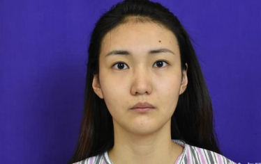 东莞壹加壹整形美容医生王擎眼鼻部手术案例
