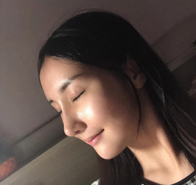 东莞壹加壹整形美容医生王擎眼鼻部手术案例