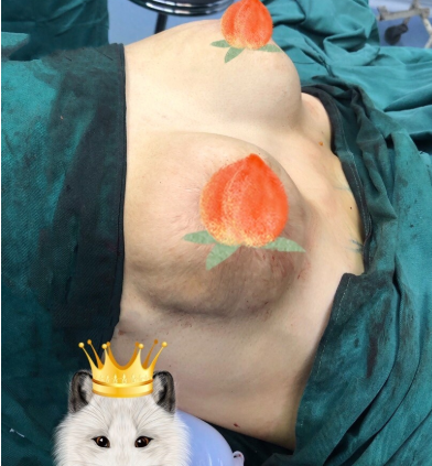 深圳做胸部下垂矫正哪里做的果好?