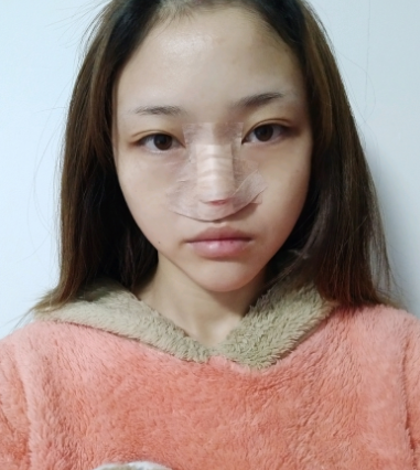 丰泽黄惠铭医疗美容诊所隆鼻案例分享!