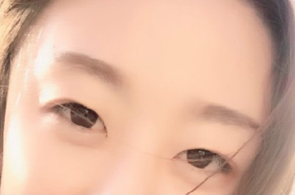 贵阳做双眼皮+膨体隆鼻的医院医生哪里好?
