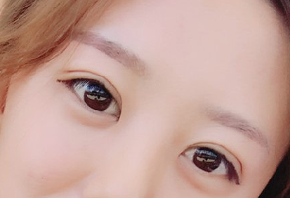 贵阳做双眼皮+膨体隆鼻的医院医生哪里好?