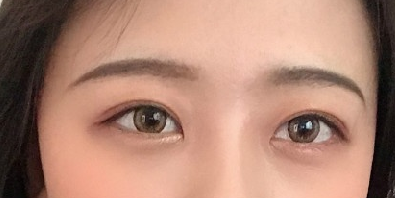 贵阳做双眼皮+膨体隆鼻的医院医生哪里好?