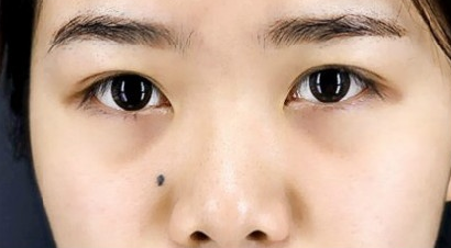 贵阳做双眼皮+膨体隆鼻的医院医生哪里好?