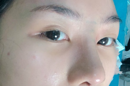 贵阳做双眼皮+膨体隆鼻的医院医生哪里好?