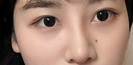 贵阳做双眼皮+膨体隆鼻的医院医生哪里好?