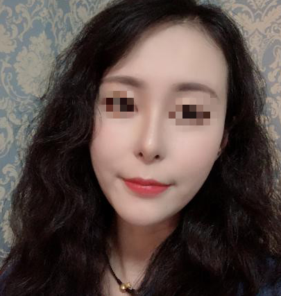 成都天姿面部填充果怎么样？