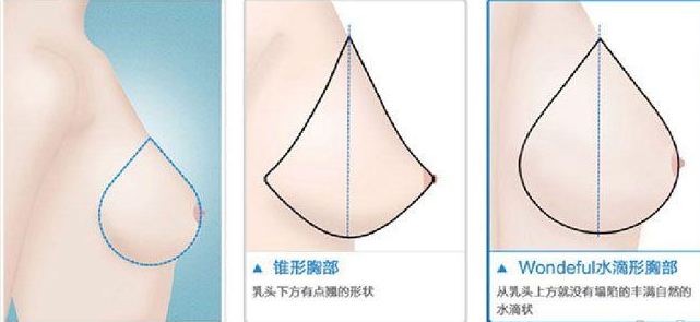瑞亚高级美医定制做胸部整形价格多少钱?