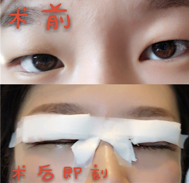 合肥立新整形医院做的眼部手术手术案例分享