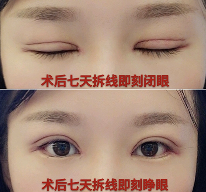 合肥立新整形医院做的眼部手术手术案例分享