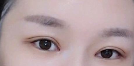 合肥立新整形医院做的眼部手术手术案例分享