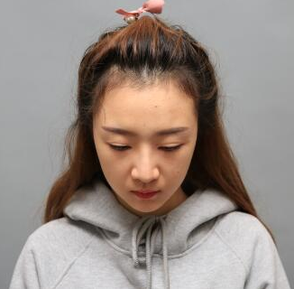 在成都做的隆鼻修复手术果案例
