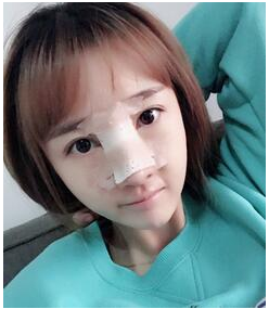 在成都做的隆鼻修复手术果案例