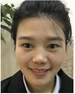 成都膨体隆鼻+耳软骨鼻尖+鼻翼塑形鼻部手术案例