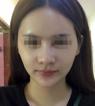 深圳鼻部手术整形手术案例