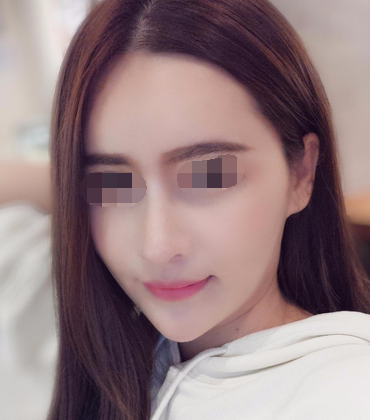 深圳鼻部手术整形手术案例