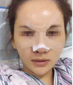 深圳鼻部手术整形手术案例