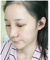 南宁鼻部手术隆鼻案例：膨体+耳软骨垫鼻尖+鼻头缩