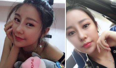 武汉半肋鼻部手术+自体脂肪面部填充案例