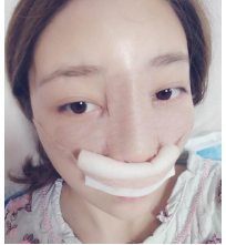 重庆军美曾令宇鼻部手术隆鼻术后恢复过程图