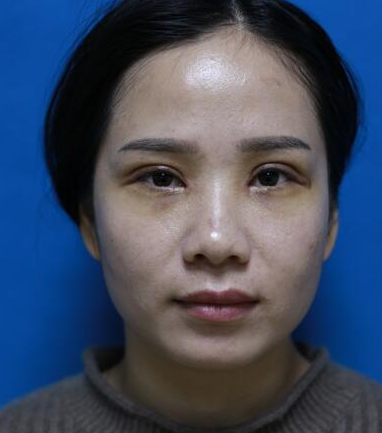苏州做的双眼皮+开内眼角手术案例