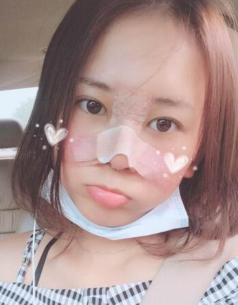 广州做的鼻部手术隆鼻手术案例